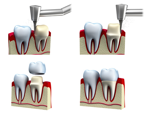 Zahnkronen Implantationsverfahren | ZahnCity