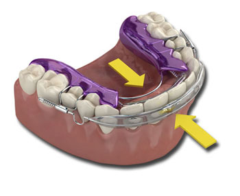 Verfahren zur Fixierung von Inman-Alignern in den Zähnen | ZahnCity