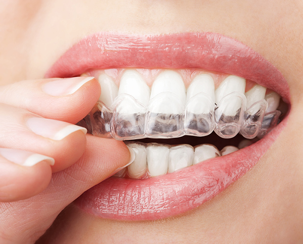 Bequem und herausnehmbar unsichtbare Zahnspangen für die Mundhygiene | ZahnCity