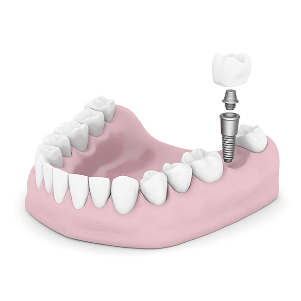 Prozess der Fixierung von Zahnimplantaten | ZahnCity