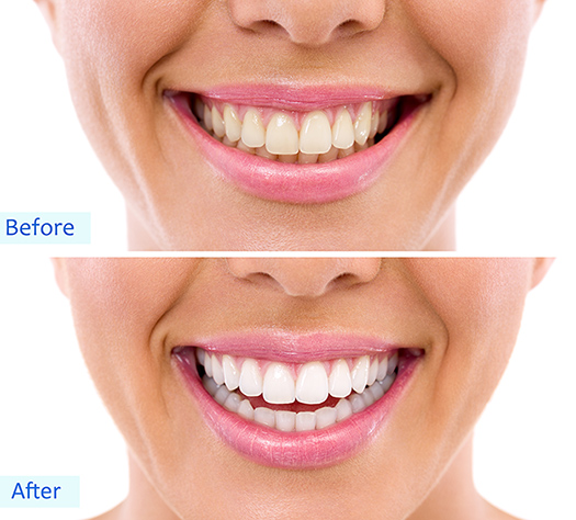 Vor und nach der Zahnaufhellung Behandlung | ZahnCity