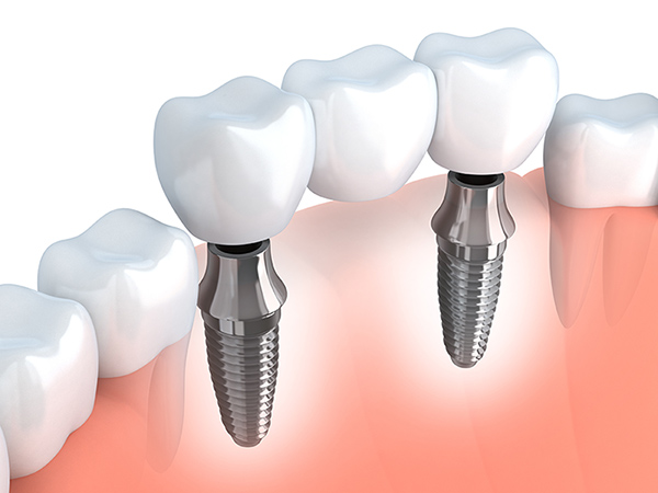 Zahnimplantate für den perfekten Lückenschluss | ZahnCity