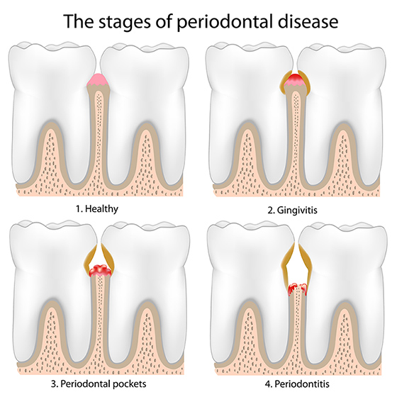 Stadien der Parodontitis und Gingivitis | ZahnCity