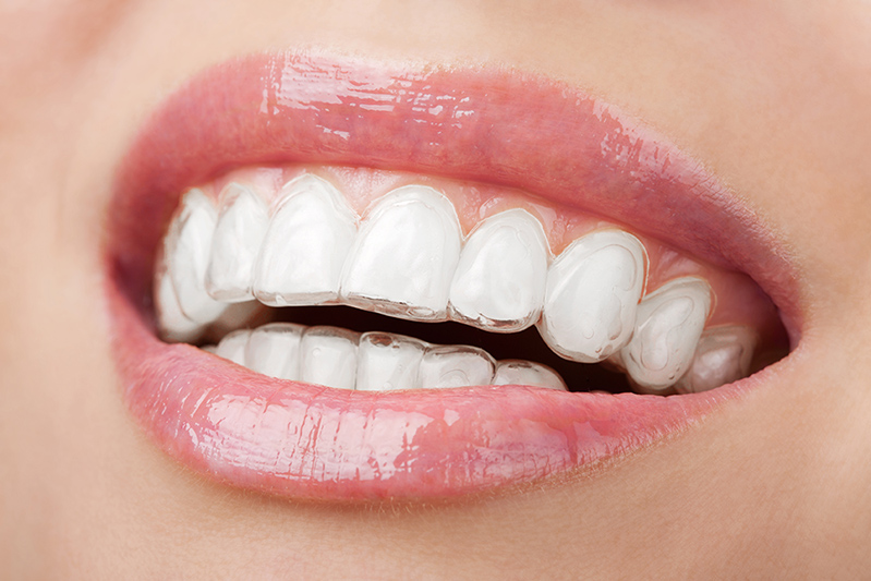 Bequeme unsichtbare Zahnspangen zur Zahnkorrektur | ZahnCity