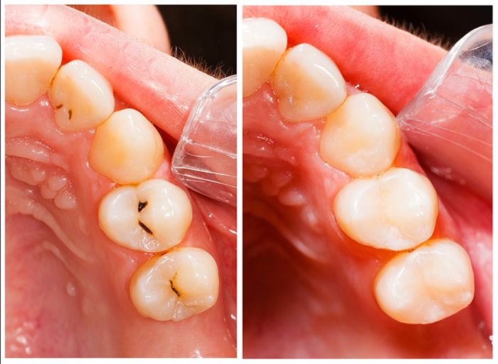 Zahnfüllung zur Karies-behandlung | ZahnCity