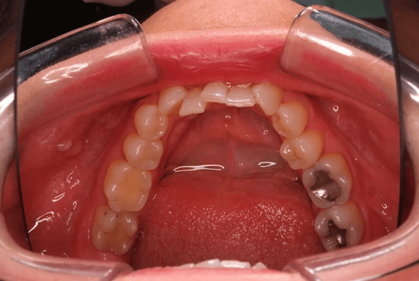 invisalign_vorher_unterkiefer.png 