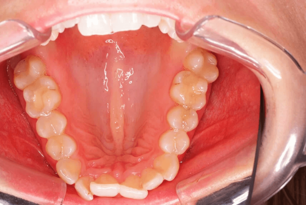 invisalign_vorher_oberkiefer.png 