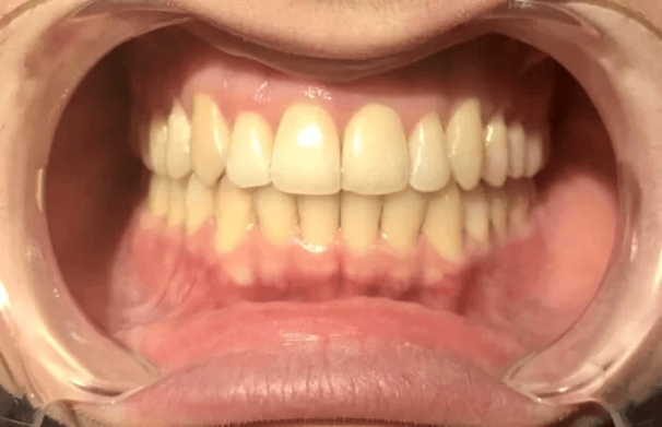 invisalign_nachher.png 