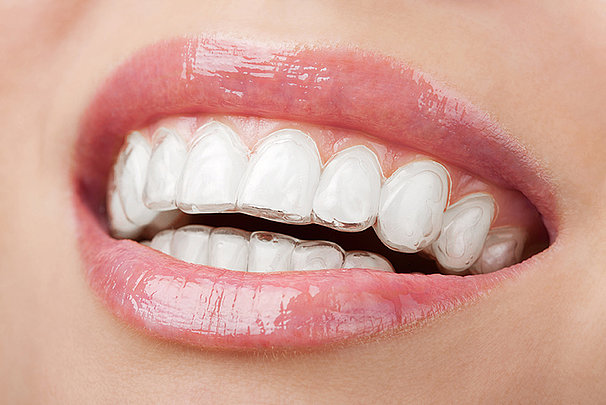 invisalign_1.jpg