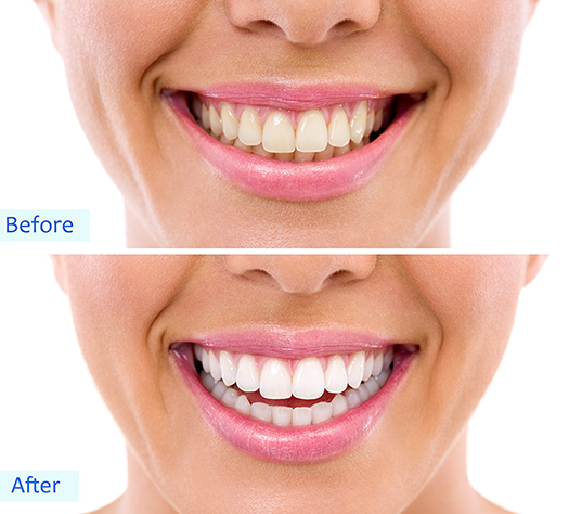 bleaching_before_after.jpg